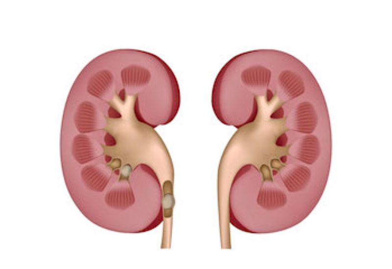 Cơ chế hình thành thận ứ nước độ 1 có sỏi