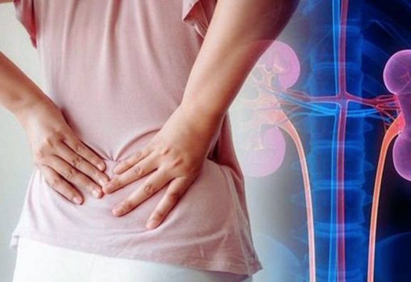 Thận ứ nước là gì và vì sao gây đau lưng?