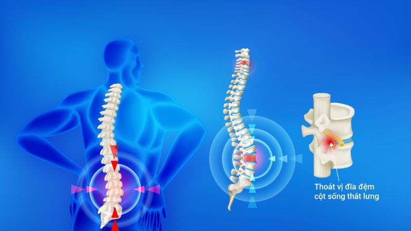 Thoát vị đĩa đệm cột sống thắt lưng là gì?