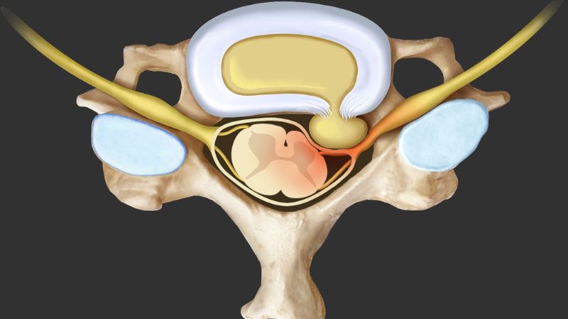 Thoát vị đĩa đệm là tình trạng gì?