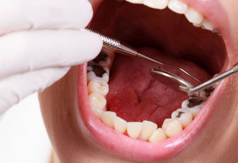 Trám răng sâu là giải pháp phục hình răng được đông đảo người dùng tin tưởng và lựa chọn nhờ hiệu quả thẩm mỹ và bảo vệ răng tốt.