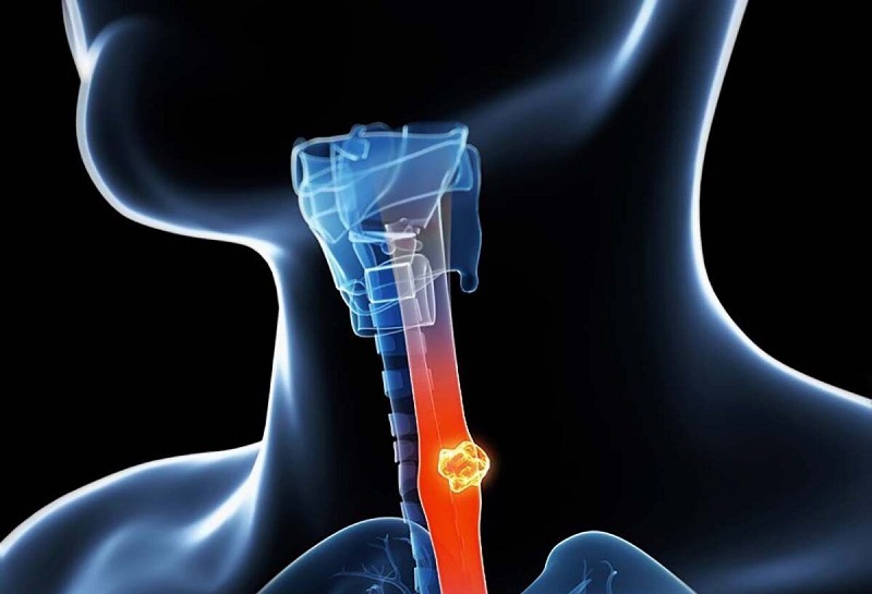 K thực quản được chia thành 4 giai đoạn chính
