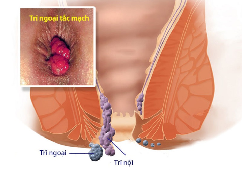 trĩ ngoại tắc mạch