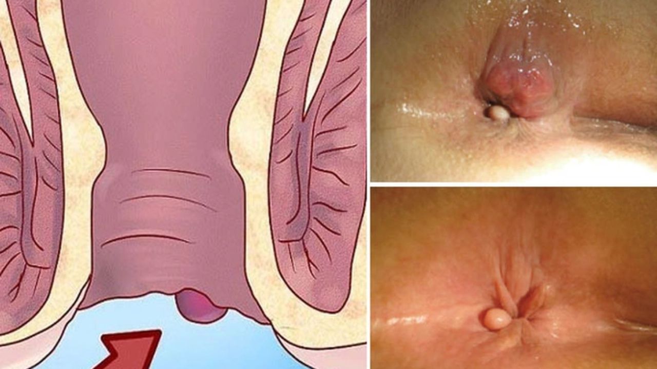 trĩ ngoại triệu chứng