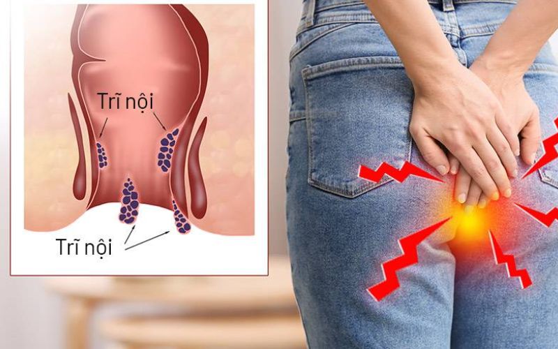 Trĩ nội biểu hiện thế nào?