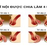 Những điều cần biết về trĩ nội cấp độ 2 và điều trị