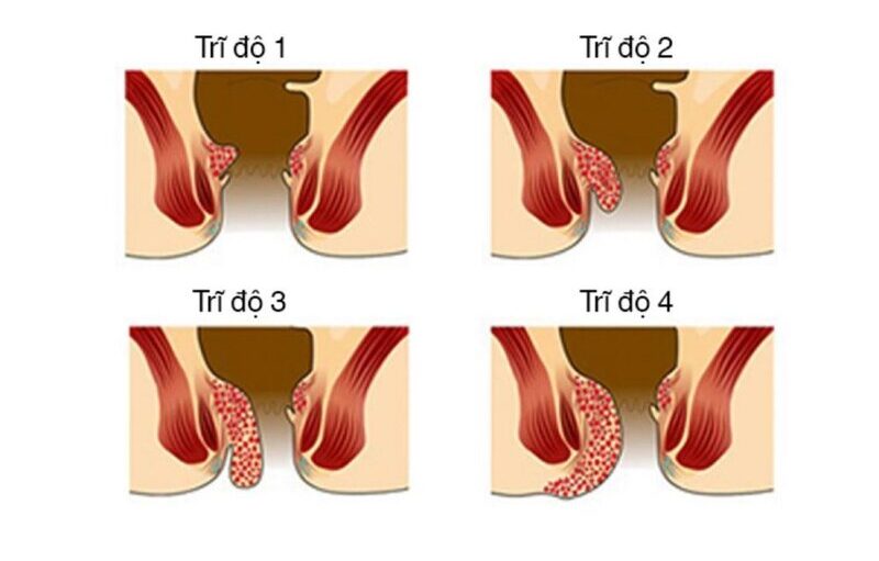 trĩ nội cấp độ 2