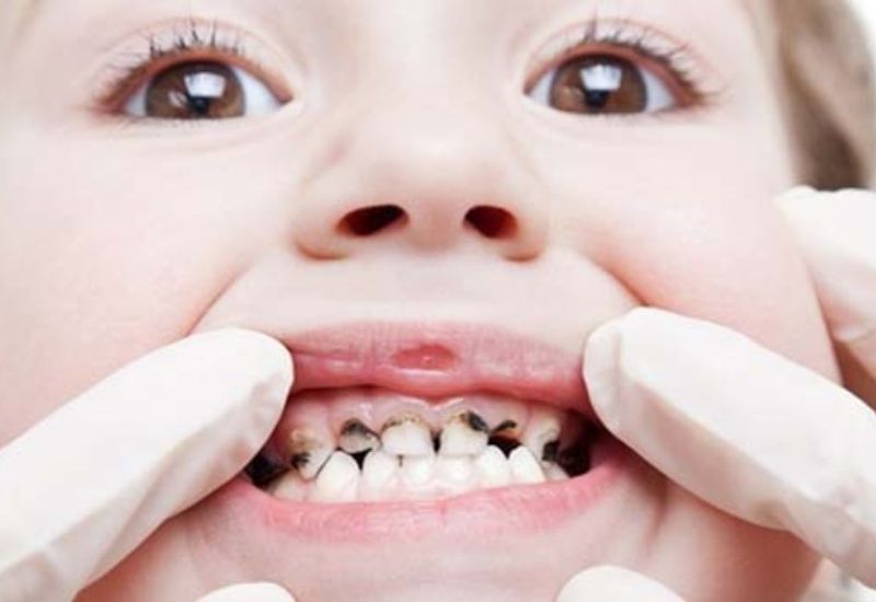 Nhiều người quan tâm đến phương pháp trị răng sâu hiệu quả