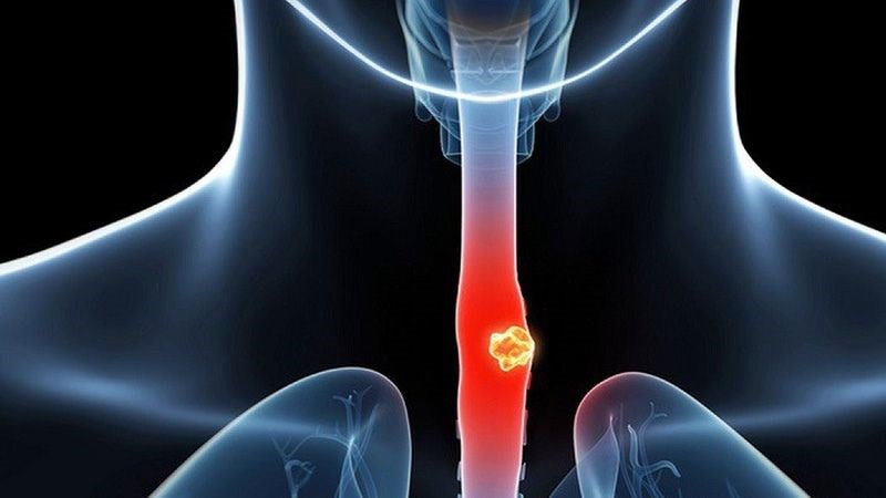 Tìm hiểu các triệu chứng viêm thực quản giúp chẩn đoán và điều trị kịp thời.