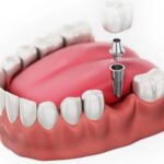 Trồng răng hàm: Chi phí và các phương pháp phổ biến hiện nay