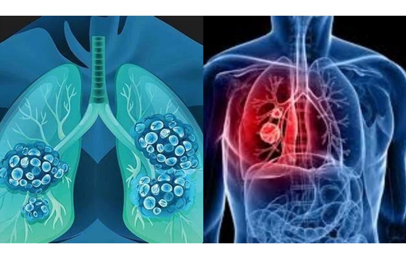 Có 2 dạng ung thư phổi phổ biến thường gặp hiện nay