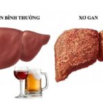 Sự nguy hiểm của xơ gan do rượu và cách phòng tránh