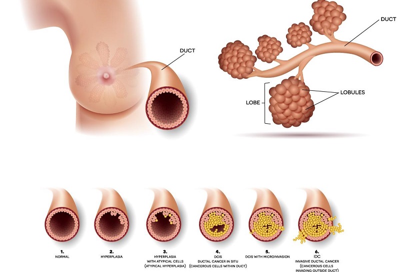 Ung thư vú là một bệnh lý ác tính xuất phát từ sự phát triển bất thường của các tế bào trong tuyến vú