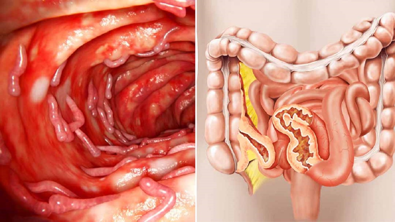 Bệnh Crohn là gì