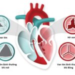Bệnh hở van tim: Các dạng chính, đặc điểm và cách điều trị