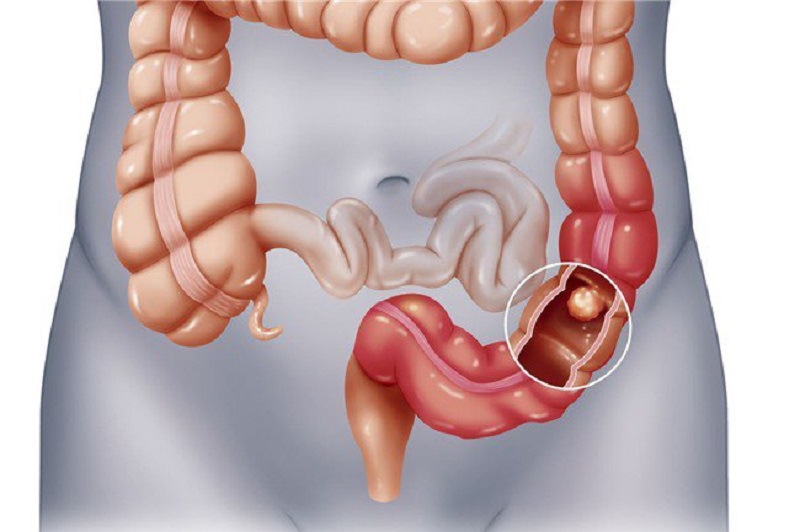 Một trong những mối nguy lớn nhất của bệnh lý Crohn là tăng nguy cơ mắc ung thư đại tràng