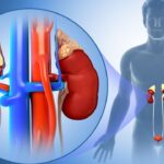 Bệnh thận ứ nước có nguy hiểm không nếu chỉ bị 1 bên