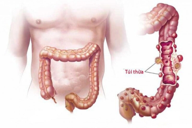 Bệnh viêm túi thừa manh tràng cần được chẩn đoán và điều trị kịp thời.