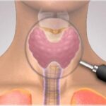 Bị viêm tuyến giáp: Dấu hiệu nhận biết sớm, chẩn đoán và điều trị đúng cách