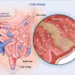 Cách chẩn đoán bệnh Crohn và phương pháp điều trị