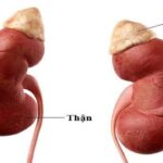 Khối u tuyến thượng thận trái là gì, chẩn đoán thế nào?