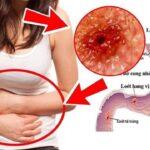 Bệnh lý viêm loét dạ dày tá tràng: Nguyên nhân, dấu hiệu cảnh báo
