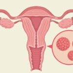 Nguy cơ bị ung thư cổ tử cung nếu mắc HPV: Những điều cần biết