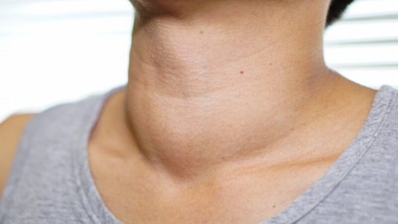 Nguyên nhân gây cường giáp, triệu chứng và biến chứng