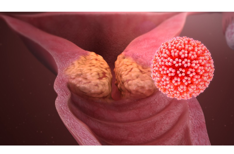 Tác nhân hàng đầu dẫn đến ung thư cổ tử cung là tình trạng nhiễm virus papilloma ở người (HPV)