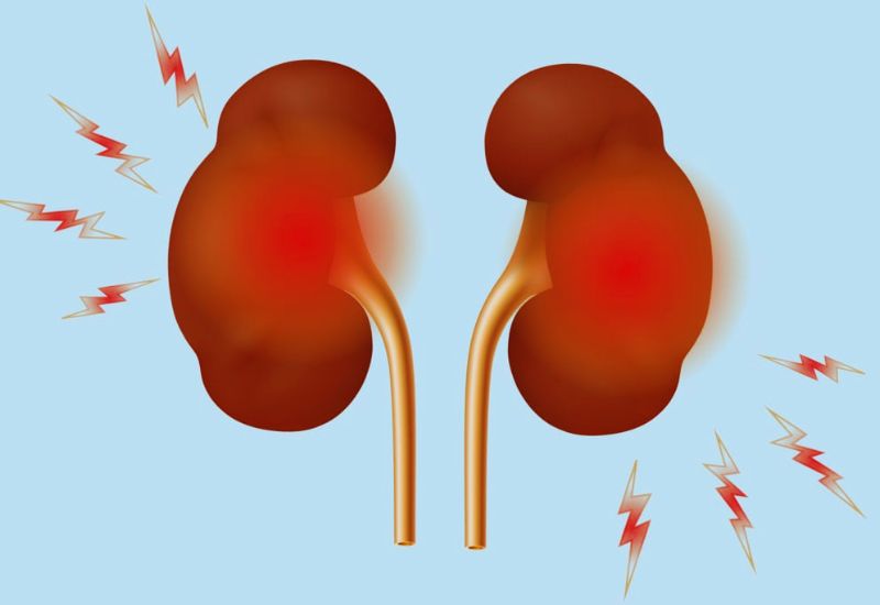 Giãn đài bể thận là gì và vì sao bệnh dễ tiến triển âm thầm?