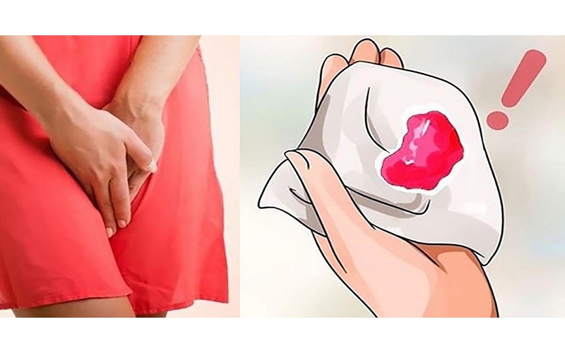 Chảy máu âm đạo là một trong những dấu hiệu phổ biến của ung thư cổ tử cung giai đoạn đầu