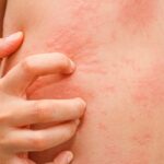 Nhận biết gan ung thư thông qua 9 triệu chứng