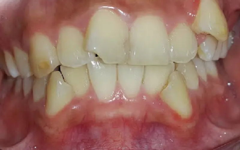 Hỏi Niềng răng có tốt không