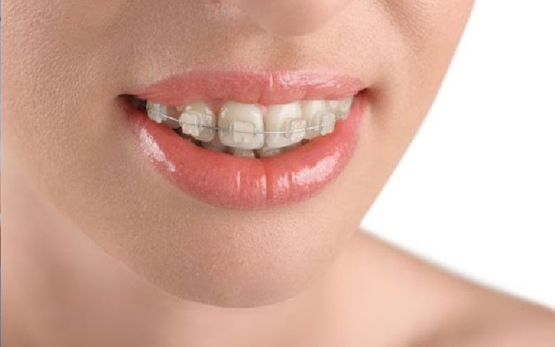 tại sao niềng răng xong vẫn xấu