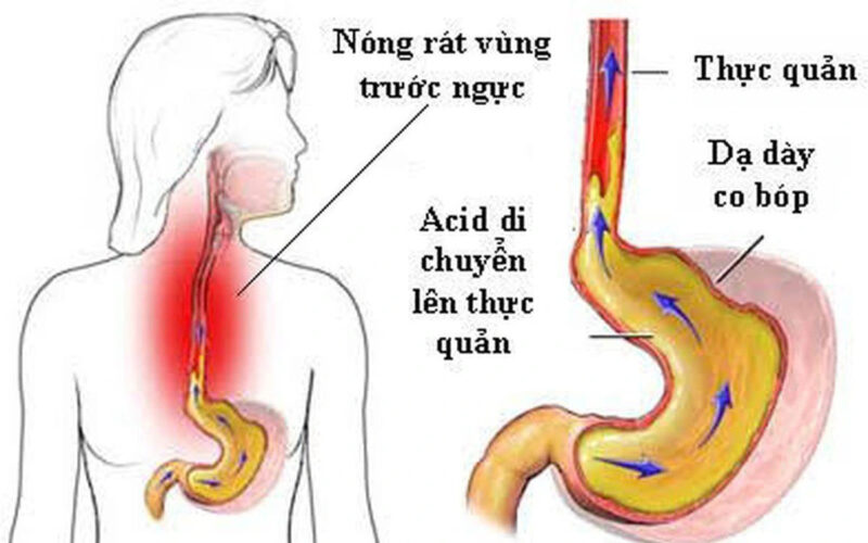 Trào ngược dạ dày thực quản là một nguyên nhân phổ biến gây nóng dạ dày.