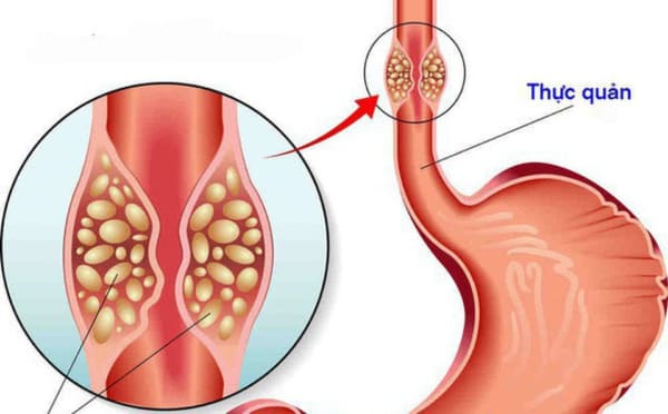 Nuốt thức ăn hay bị nghẹn có thể do bệnh lý ở thực quản gây ra.