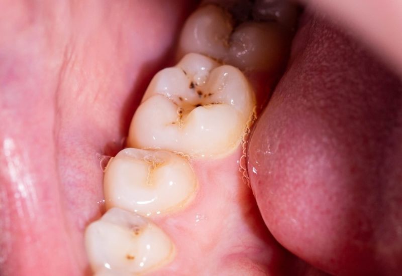 Sâu răng nhẹ là giai đoạn khởi đầu của bệnh sâu răng – một vấn đề răng miệng phổ biến hiện nay.
