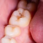 Sâu răng nhẹ: Triệu chứng thường gặp và giải pháp điều trị kịp thời