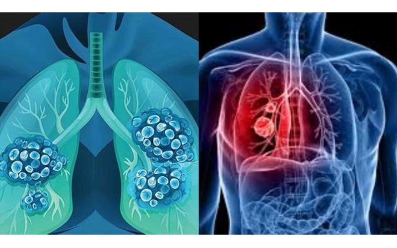 Ung thư phổi là một loại bệnh ác tính phát sinh từ các tế bào trong mô phổi