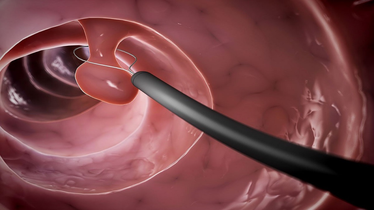 Tìm hiểu về polyp đại tràng