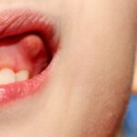 Trị sưng lợi ở trẻ em: Những điều cha mẹ cần lưu ý