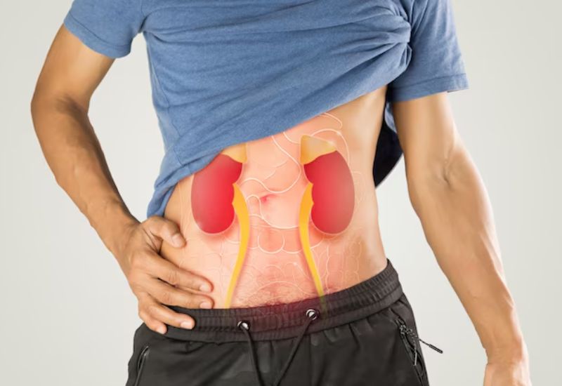 Những dấu hiệu điển hình của giãn đài bể thận cần cảnh giác