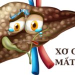 Những lưu ý quan trọng khi điều trị xơ gan mất bù