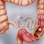 Yếu tố làm tăng nguy cơ mắc bệnh ung thư đại tràng