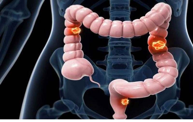 ng thư đại tràng (Colon Cancer) là dạng ung thư bắt nguồn từ đại tràng - phần chính của ruột già trong hệ tiêu hóa